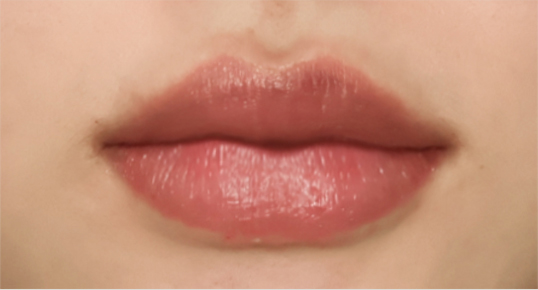 Botox