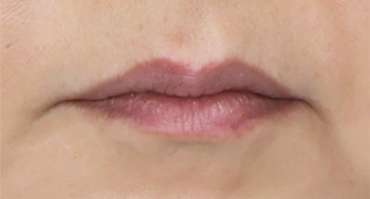 Filler – Nasolabial Fold / Perioral