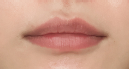 Full Face Filler