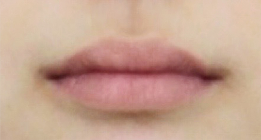Ultherapy Prime