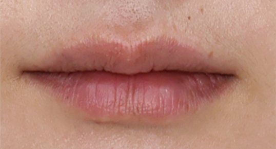 Skin Booster – Juvelook / Sculptra / Collaum (Skin Density)