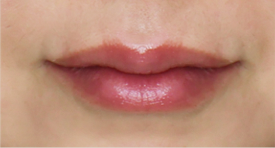 Filler – Chin / Lower Face